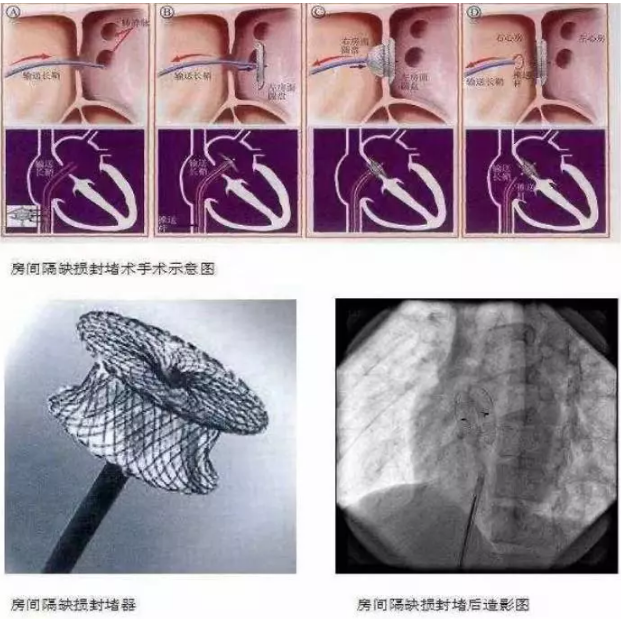 徐州市儿童先天性心脏病介入手术治疗