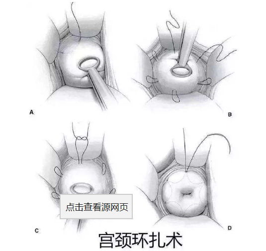 曾因宫颈机能不全妊娠终止，现二胎喜怀双胞胎