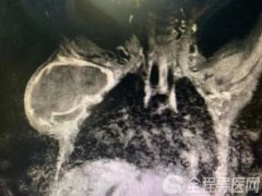 男孩腋下忽然长出巨大肿块 徐州市儿童医院介入手术治疗淋巴管畸形
